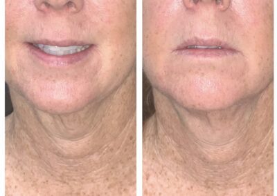result of treatment can be seen on the before and after images